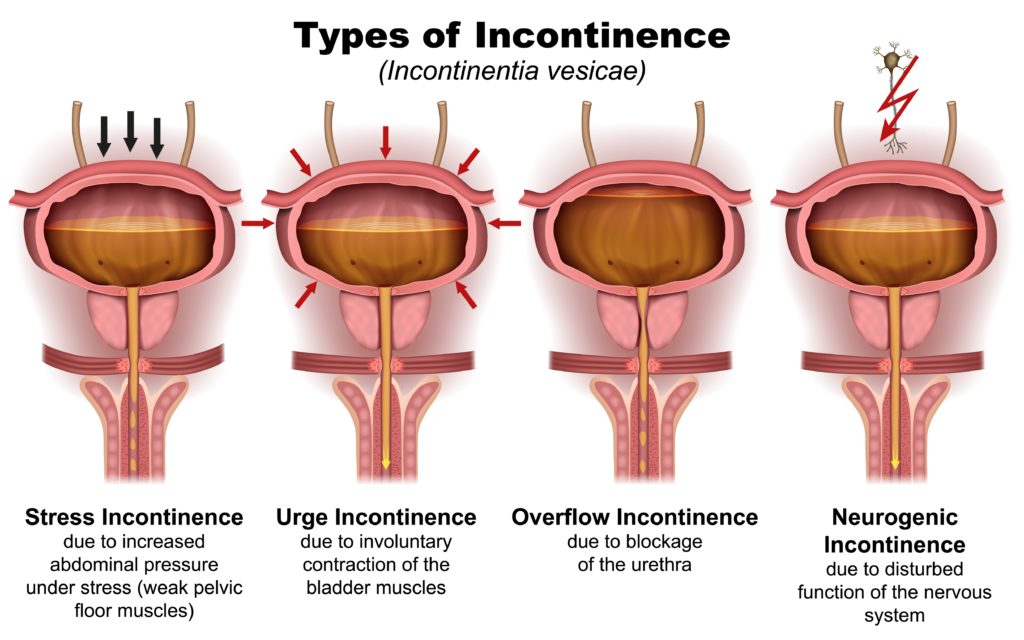 Causes Types Of Stress Urinary Incontinence Chicago Urogynecology